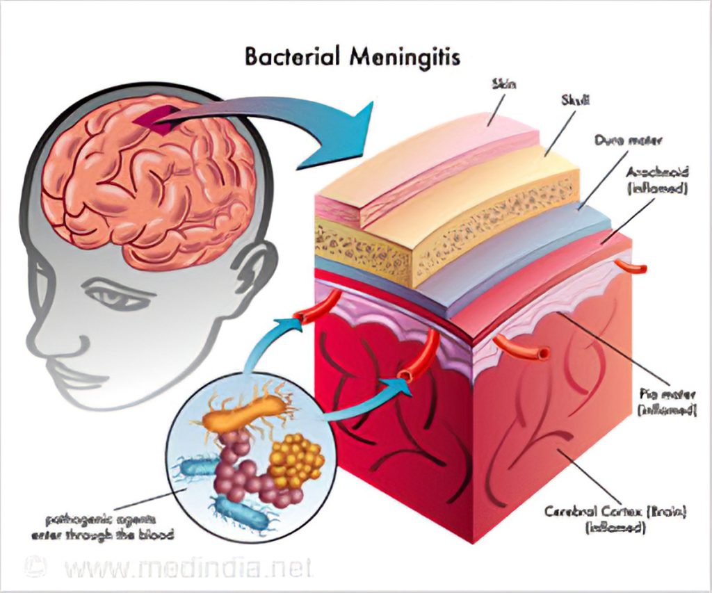 bacterial meningitis