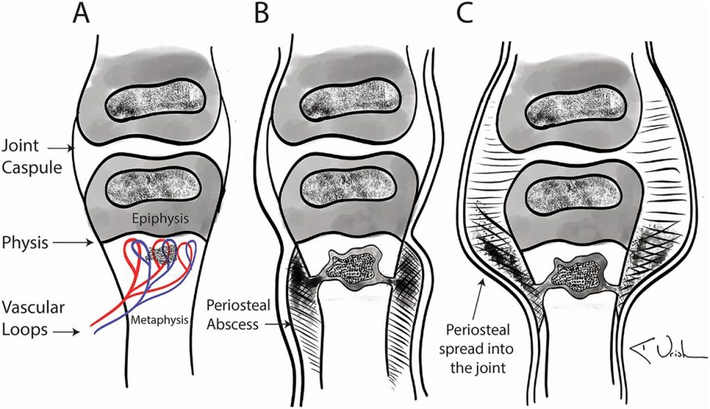 Osteomyelitis