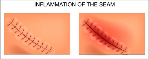 surgical site infection