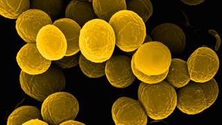 Staphylococcus aureus in Patients Diagnosed With Bronchiectasis Without Cystic Fibrosis - Pulmonology Advisor