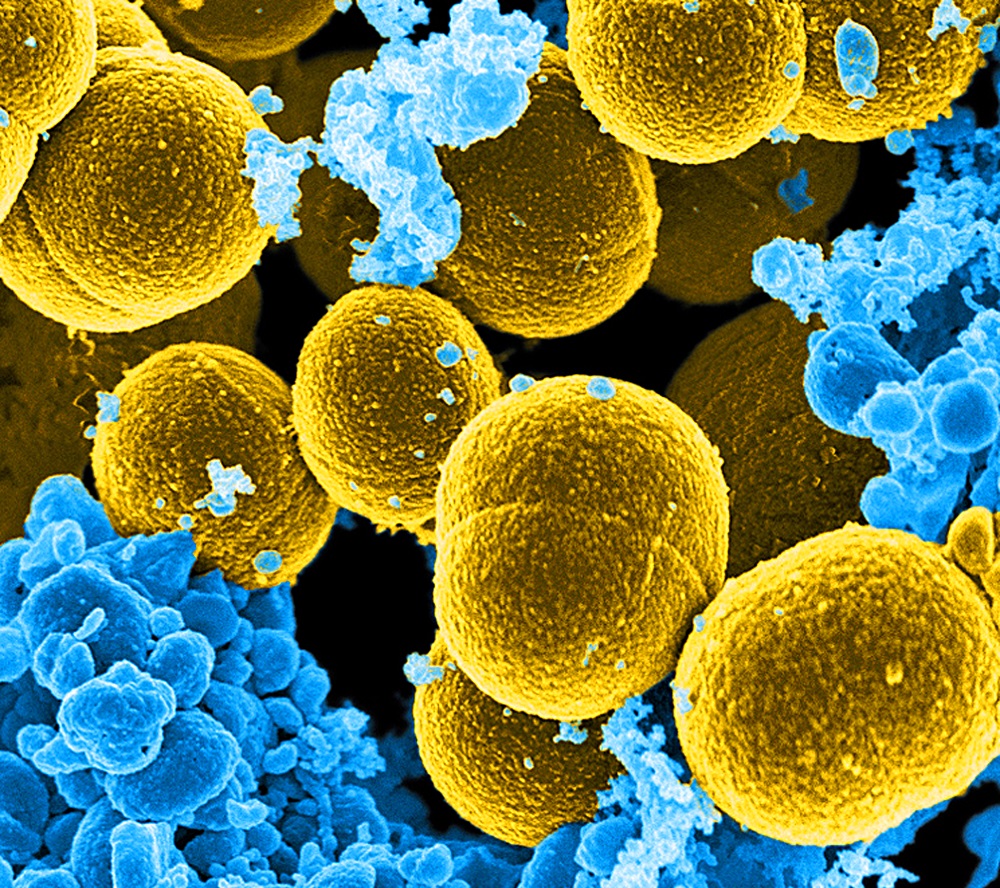 Staphylococcus aureus in Patients Diagnosed With Bronchiectasis Without Cystic Fibrosis - Pulmonology Advisor