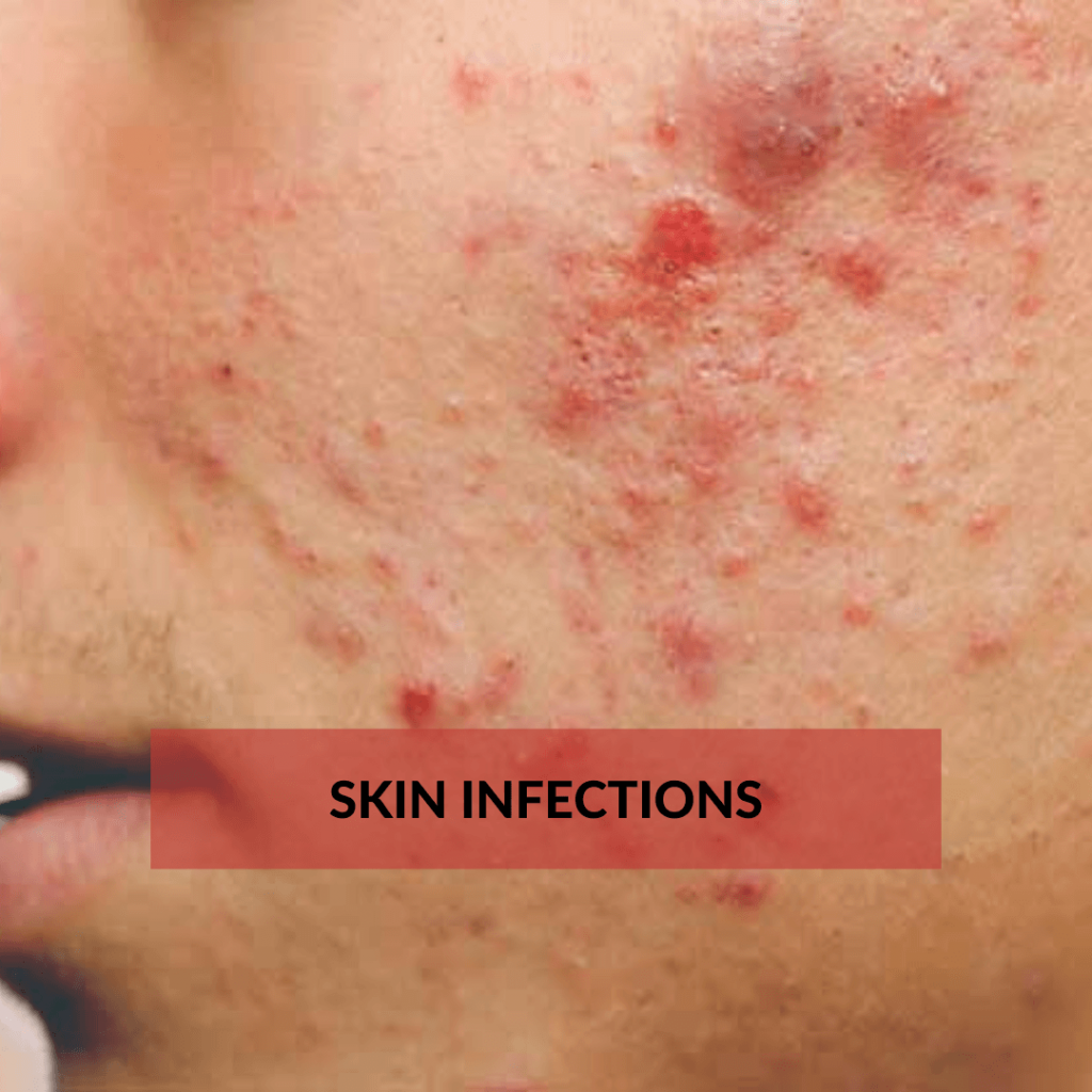 skin infections
