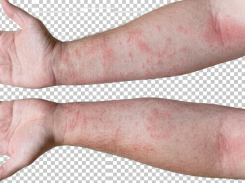 Best Healing Lotion for Eczema